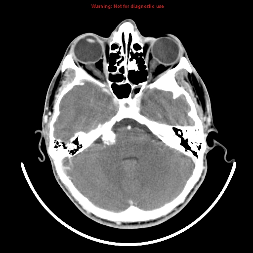 File:Neurofibromatosis type 2 (Radiopaedia 8953-9732 C 8).jpg