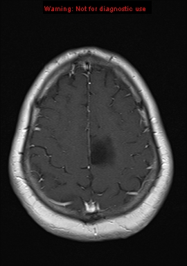File:Neuroglial cyst (Radiopaedia 10713-11184 Axial T1 C+ 5).jpg