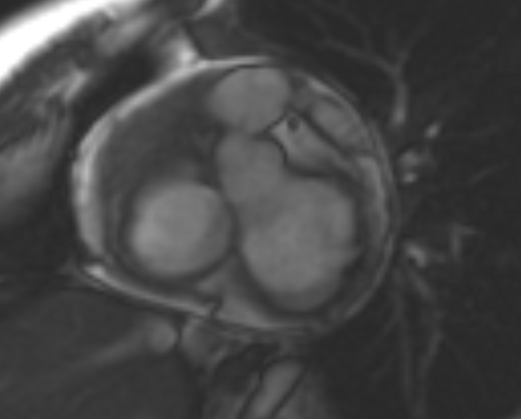 File:Non-compaction of the left ventricle (Radiopaedia 69436-79314 Short axis cine 219).jpg