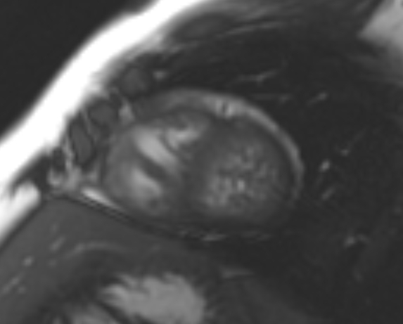 File:Non-compaction of the left ventricle (Radiopaedia 69436-79314 Short axis cine 68).jpg