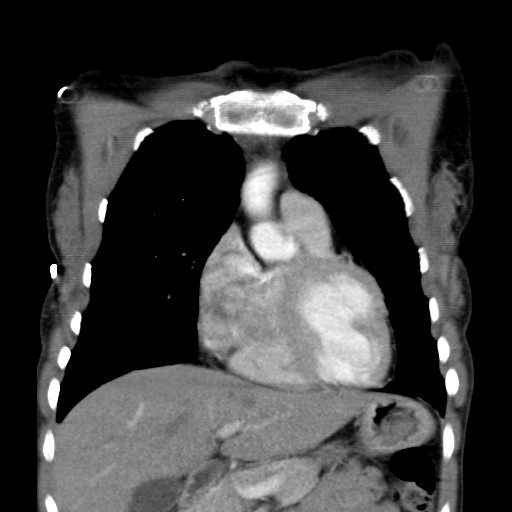 File:Non-small cell lung cancer with miliary metastases (Radiopaedia 23995-24193 B 6).jpg