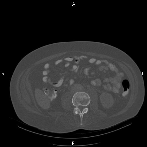 Non Hodgkin lymphoma in a patient with ankylosing spondylitis (Radiopaedia 84323-99624 Axial bone window 44).jpg