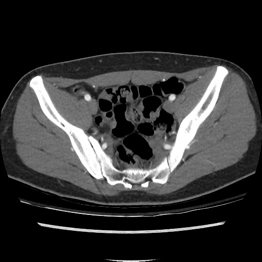 File:Normal CT angiogram of pelvis (Radiopaedia 45390-49430 A 35).jpg