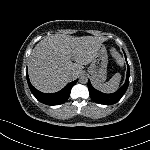 Normal CT chest- adult female (Radiopaedia 52522-58428 Axial non-contrast 117).jpg