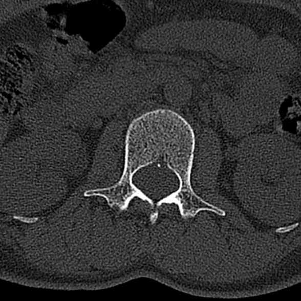 File:Normal CT lumbar spine (Radiopaedia 53981-60118 Axial bone window 23).jpg