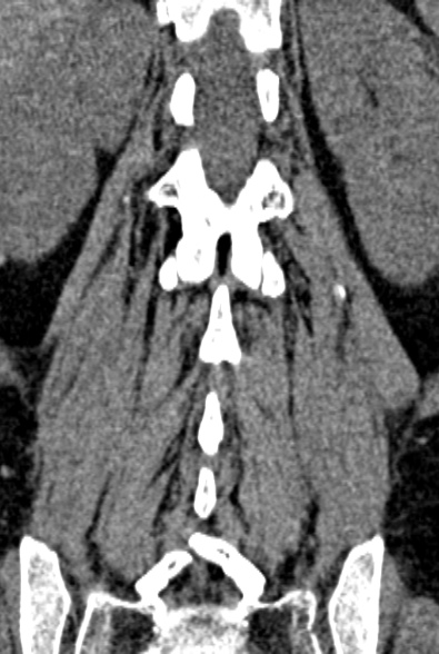 Normal CT lumbar spine (Radiopaedia 53981-60118 F 70).jpg