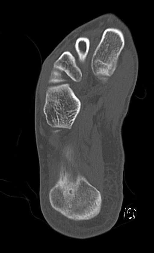 Normal CT of the ankle (Radiopaedia 47111-51658 Axial bone window 82).jpg