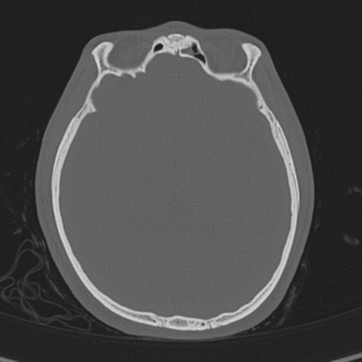 Normal CT skull (Radiopaedia 40798-43459 A 81).png