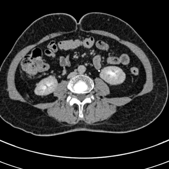 File:Normal CT split bolus study of the renal tract (Radiopaedia 48631-53634 Axial split bolus 141).jpg