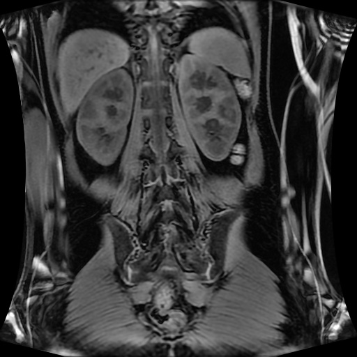 Normal MRI abdomen in pregnancy (Radiopaedia 88001-104541 M 105).jpg