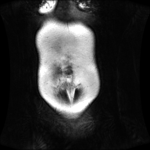 Normal MRI abdomen in pregnancy (Radiopaedia 88001-104541 N 22).jpg