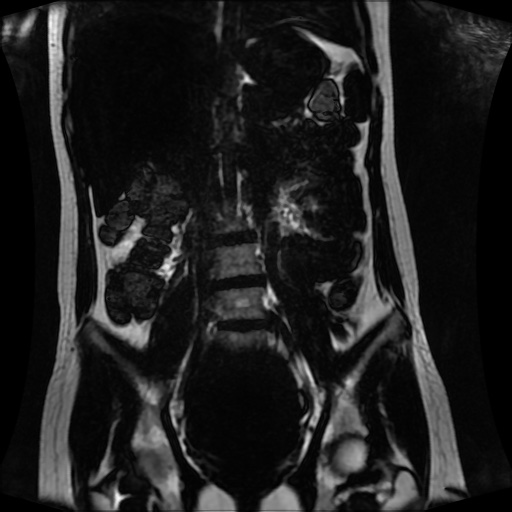 Normal MRI abdomen in pregnancy (Radiopaedia 88001-104541 N 78).jpg