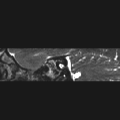 Normal MRI internal auditory canal (Radiopaedia 41613-44525 C 34).png