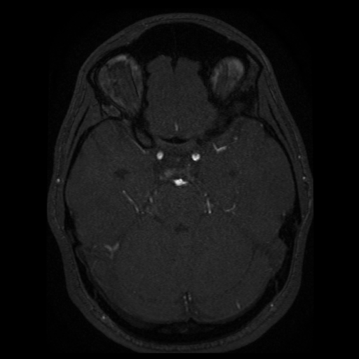 Normal brain MRA (Radiopaedia 41046-43793 Axial MRA 62).png
