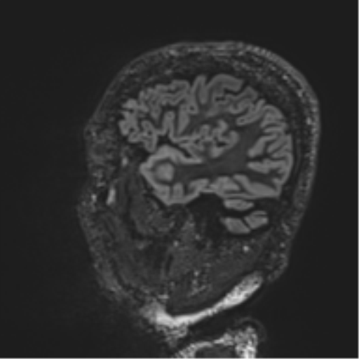 Normal brain MRI (non-focal epilepsy protocol) (Radiopaedia 53917-60040 Sagittal DIR 16).png
