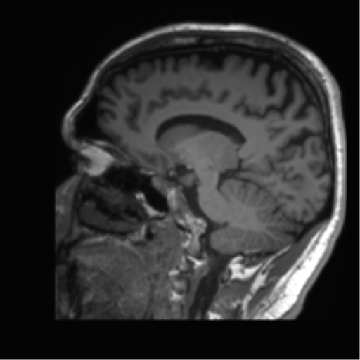 Normal brain MRI (non-focal epilepsy protocol) (Radiopaedia 53917-60040 Sagittal T1 40).png