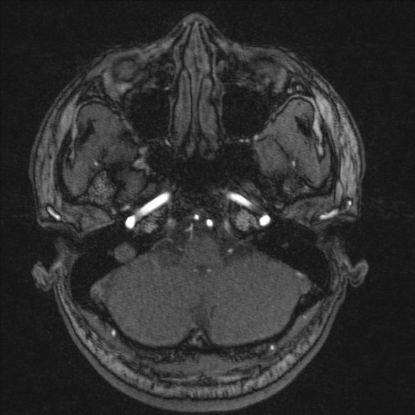 Normal brain MRI including MRA (Radiopaedia 48748-53763 Axial MRA 31).jpg