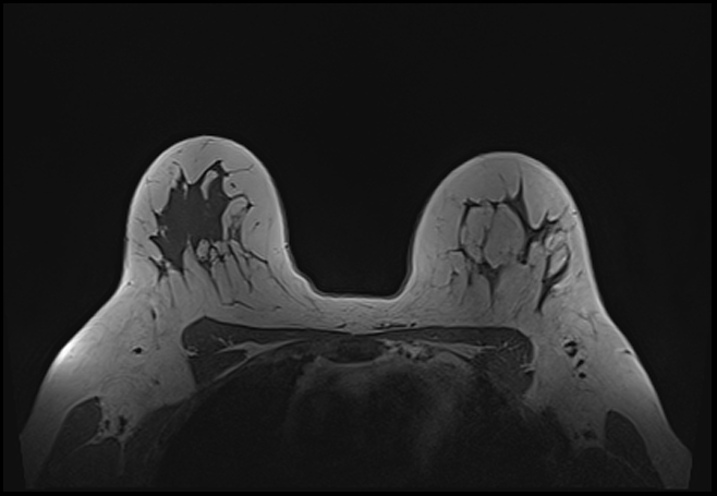 File:Normal breast MRI - dense breasts (Radiopaedia 80454-93850 Axial T1 155).jpg