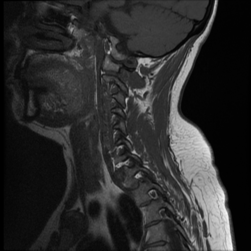 File:Normal cervical and thoracic spine MRI (Radiopaedia 35630-37156 Sagittal T1 10).png
