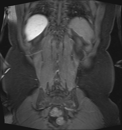 File:Normal hepatobiliary phase liver MRI (Radiopaedia 58968-66230 B 6).jpg