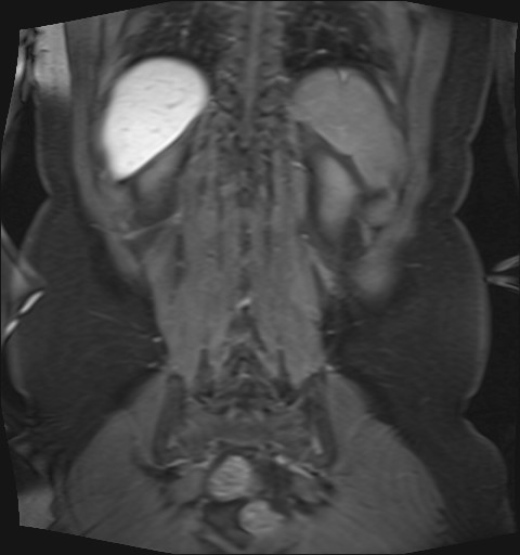 File:Normal hepatobiliary phase liver MRI (Radiopaedia 58968-66230 B 7).jpg