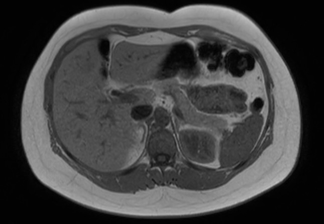 File:Normal liver MRI with Gadolinium (Radiopaedia 58913-66163 Axial T1 in-phase 20).jpg