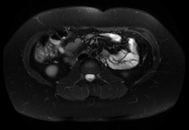 File:Normal liver MRI with Gadolinium (Radiopaedia 58913-66163 Axial T2 fat sat 12).jpg