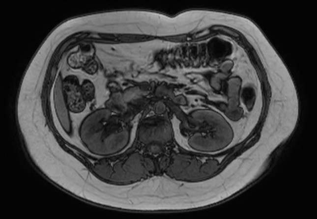 File:Normal liver MRI with Gadolinium (Radiopaedia 58913-66163 B 14).jpg