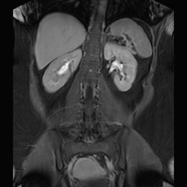 Normal liver MRI with Gadolinium (Radiopaedia 58913-66163 P 59).jpg