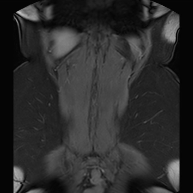 Normal liver MRI with Gadolinium (Radiopaedia 58913-66163 P 76).jpg