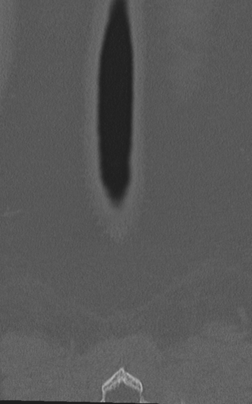Normal lumbar spine CT (Radiopaedia 46533-50986 Coronal bone window 83).png