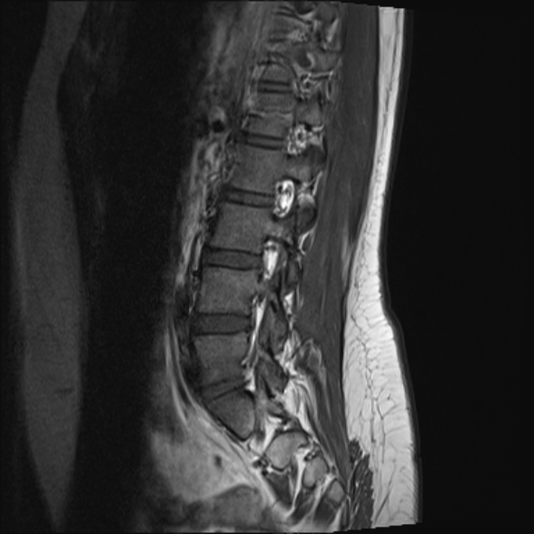 File:Normal lumbar spine MRI- 3 T (Radiopaedia 53280-59250 Sagittal T1 17).jpg