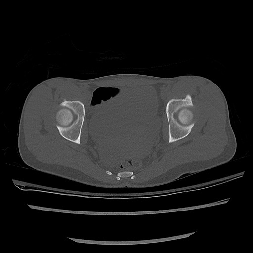 Normal pelvis CT (Radiopaedia 51471-57236 Axial bone window 65).jpg
