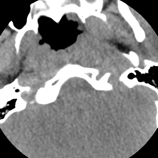 Normal trauma cervical spine (Radiopaedia 41017-43760 Axial non-contrast 6).png