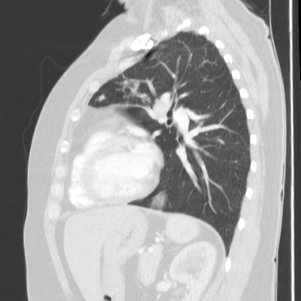 Obstructing typical carcinoid causing bronchoceles (Radiopaedia 50149-55476 Sagittal lung window 38).png