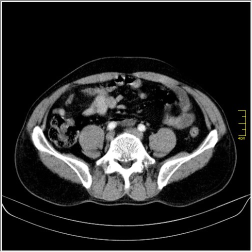 Obstruction due to small bowel bezoar (Radiopaedia 59583-66981 A 104).JPG