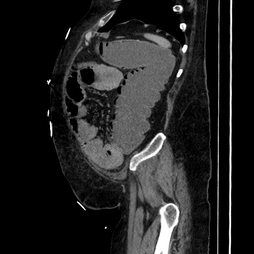Obstructive colonic diverticular stricture (Radiopaedia 81085-94675 C 191).jpg
