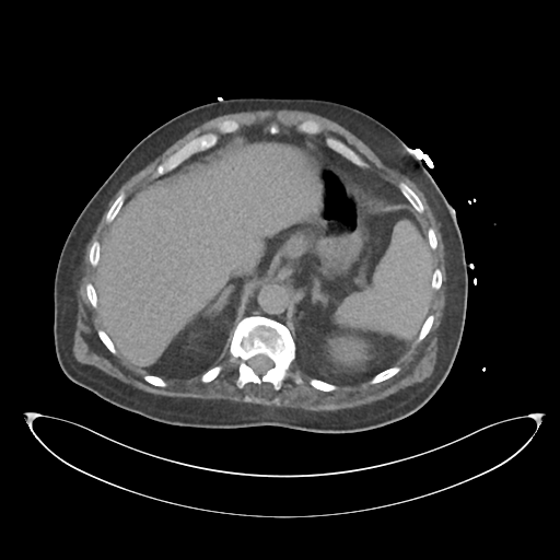 File:Obstructive pyelonephritis (Radiopaedia 46411-50844 Axial non-contrast 19).png