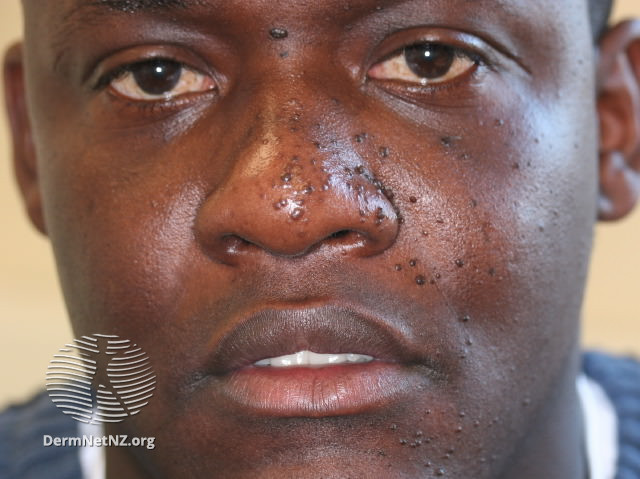 File:Unilateral angiofibromas on the nose and face of a black skinned male. (DermNet NZ facial-angiofibromas-17).jpg