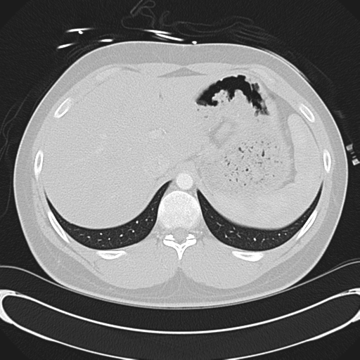 File:'Bovine' aortic arch (Radiopaedia 33554-34637 Axial lung window 60).png