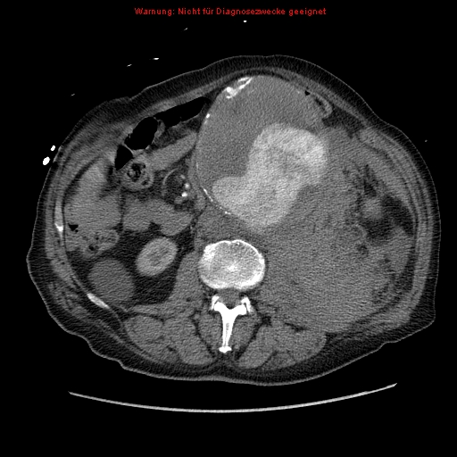 File:Abdominal aortic aneurysm- extremely large, ruptured (Radiopaedia 19882-19921 Axial C+ arterial phase 33).jpg