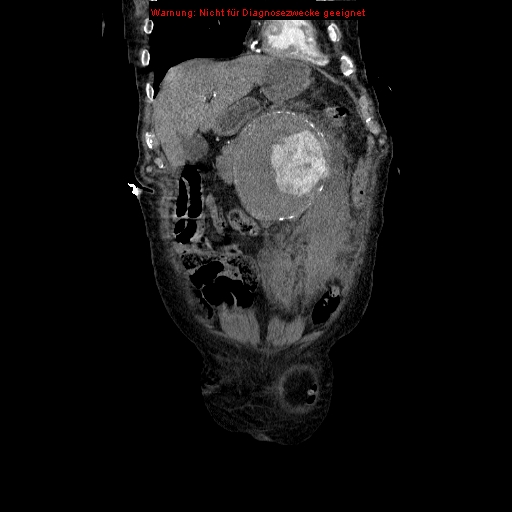 File:Abdominal aortic aneurysm- extremely large, ruptured (Radiopaedia 19882-19921 Coronal C+ arterial phase 25).jpg