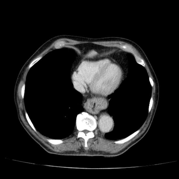 Abdominal aortic aneurysm (Radiopaedia 29248-29660 Axial C+ portal venous phase 6).jpg