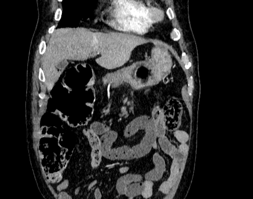 Abdominal aortic aneurysm (Radiopaedia 67117-76452 Coronal C+ arterial phase 7).jpg