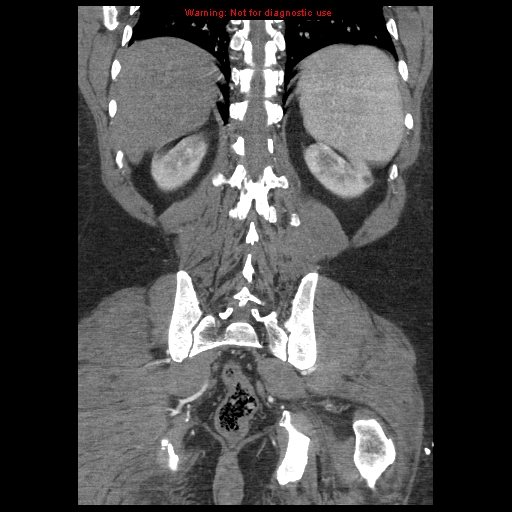 Abdominal aortic aneurysm (Radiopaedia 8190-9038 Coronal C+ arterial phase 101).jpg