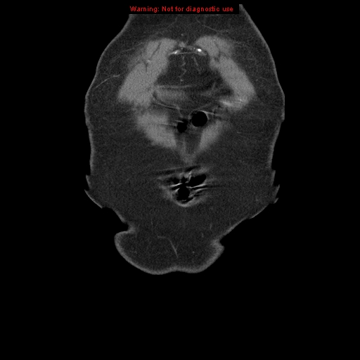 Abdominal aortic aneurysm (Radiopaedia 8190-9038 Coronal C+ arterial phase 6).jpg