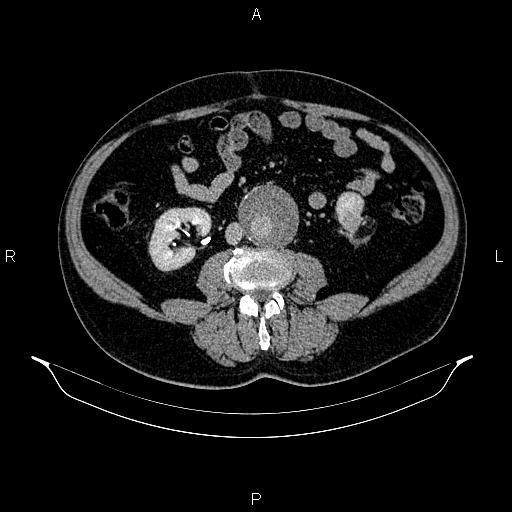 Abdominal aortic aneurysm (Radiopaedia 83094-97462 Axial renal excretory phase 60).jpg