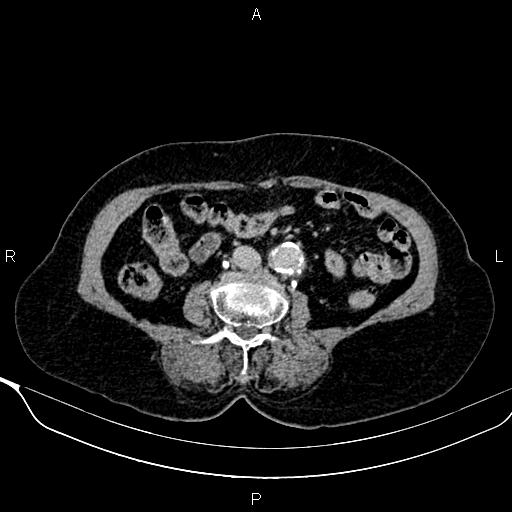 File:Abdominal aortic aneurysm (Radiopaedia 85063-100606 Axial C+ delayed 69).jpg