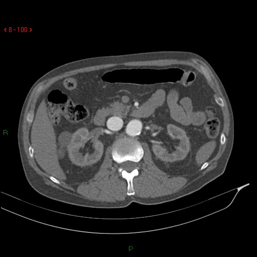 Abdominal aortic aneurysm rupture with aortocaval fistula (Radiopaedia 14897-14841 Axial C+ arterial phase 100).jpg