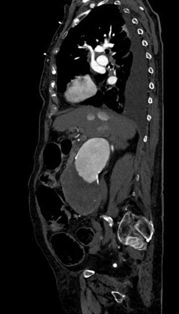 Abdominal aortic aneurysm with thrombus fissuration (Radiopaedia 73192-83919 Sagittal C+ arterial phase 88).jpg